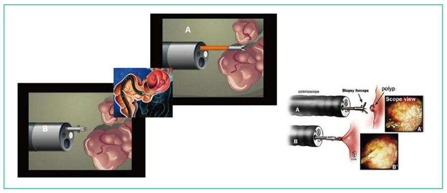 Endoscope Sampling Forceps Usage