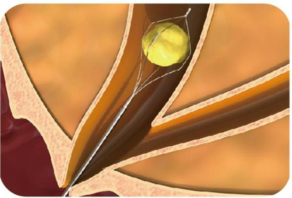 Disposable Endoscope Stone Extraction Basket Usage