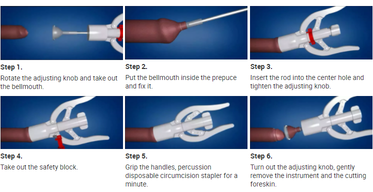 circumcision stapler use step