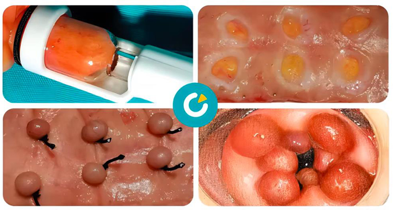 hemorrhoid ligation surgery