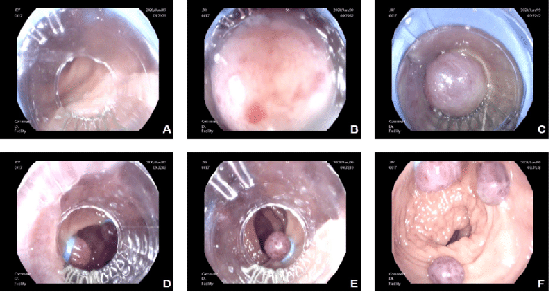 The operation procedure of ligation of internal hemorrhoids B A transparent plastic