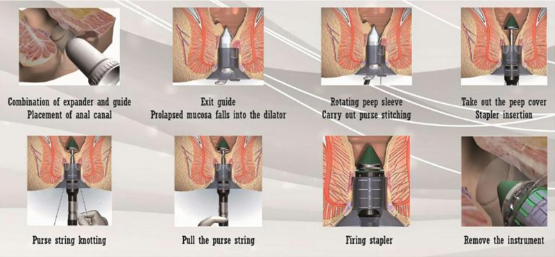 Anorectal Ligation Stapler use instruction