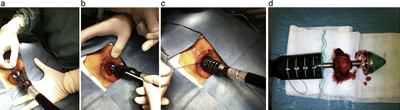 Disposable PPH Stapler Surgery Image