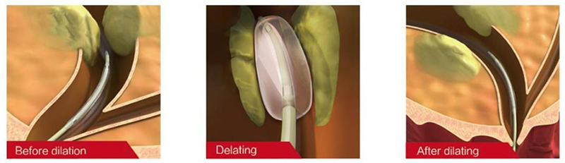 Dilation Balloon Catheter Usage