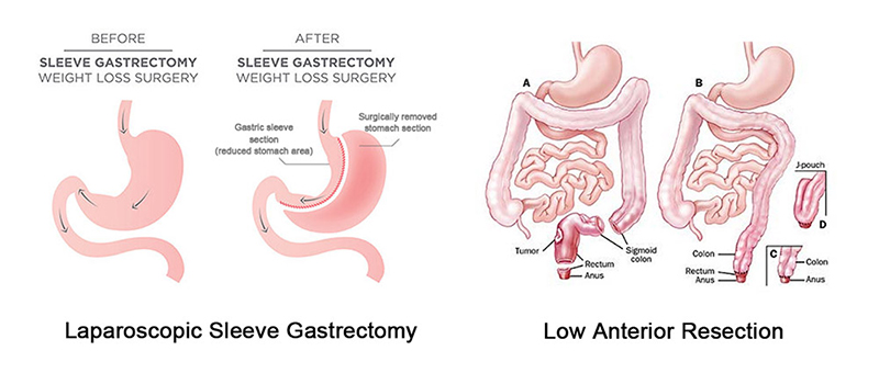 gastrointestinal surgery cutting stapler