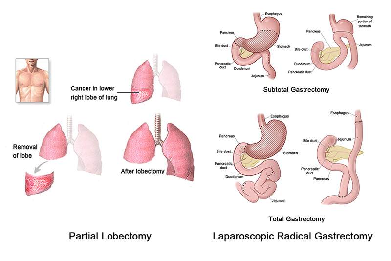 staper for laparoscopic surgery